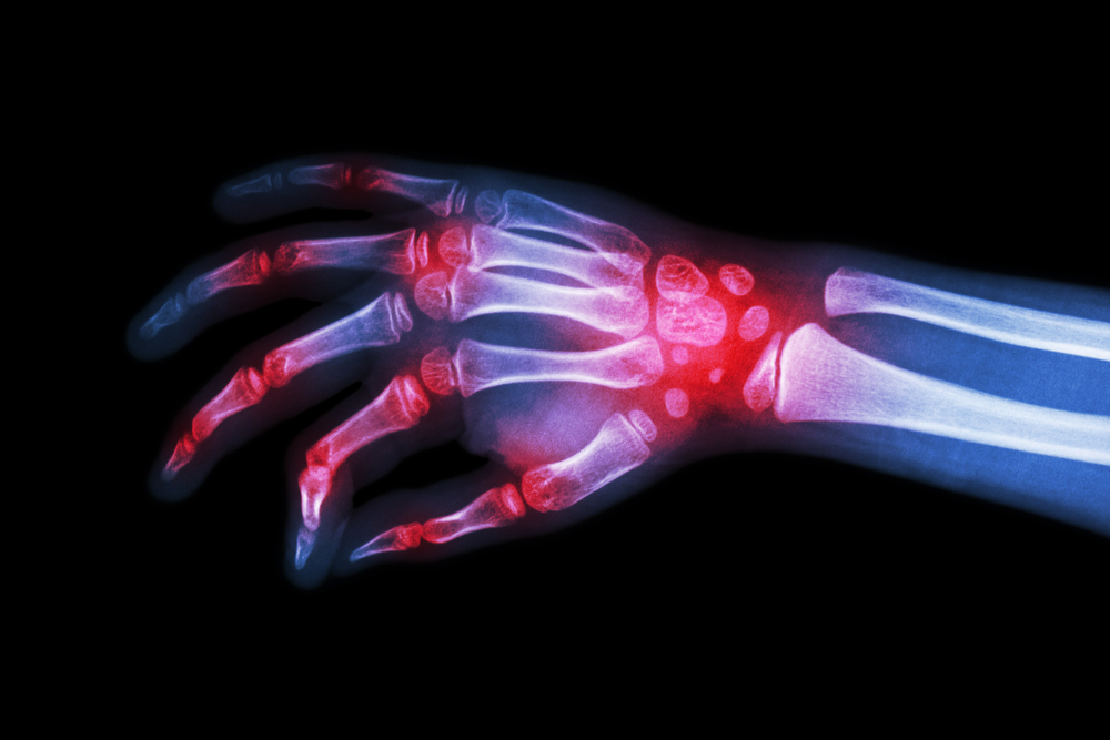 Rheumatoid Arthritis: Causes and coverings of RA